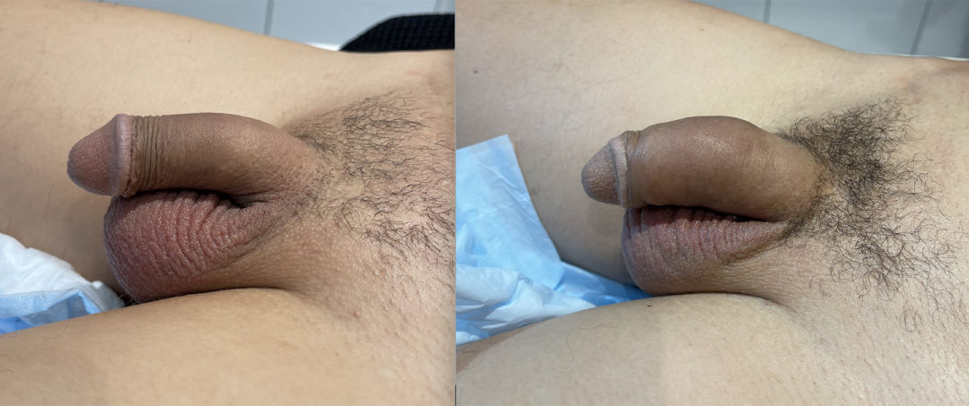 Penile Filler Before and After Photo by Dr. Emer in West Hollywood, CA