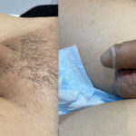 Penile Filler Before and After Photo by Dr. Emer in West Hollywood, CA