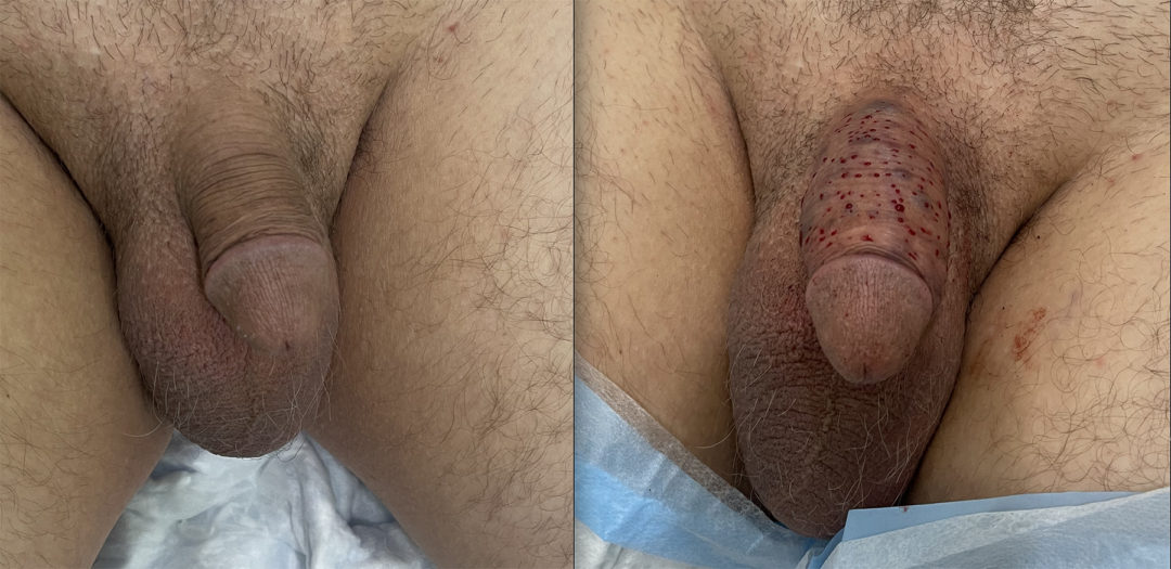 Penile Filler Before and After Photo by Dr. Emer in West Hollywood, CA