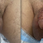 Penile Filler Before and After Photo by Dr. Emer in West Hollywood, CA