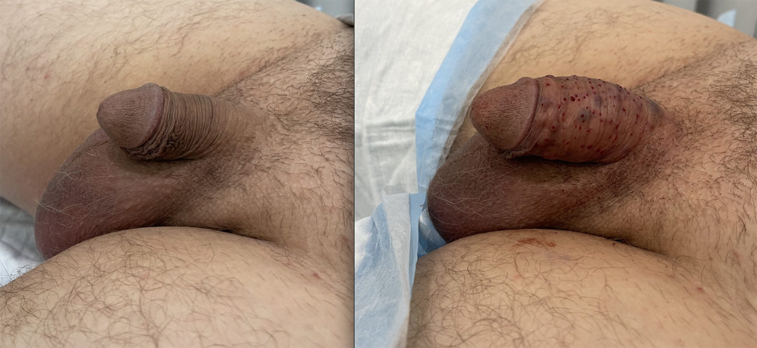 Penile Filler Before and After Photo by Dr. Emer in West Hollywood, CA