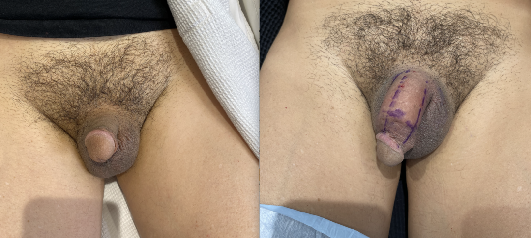 Penile Filler Before and After Photo by Dr. Emer in West Hollywood, CA