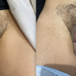 Penile Filler Before and After Photo by Dr. Emer in West Hollywood, CA