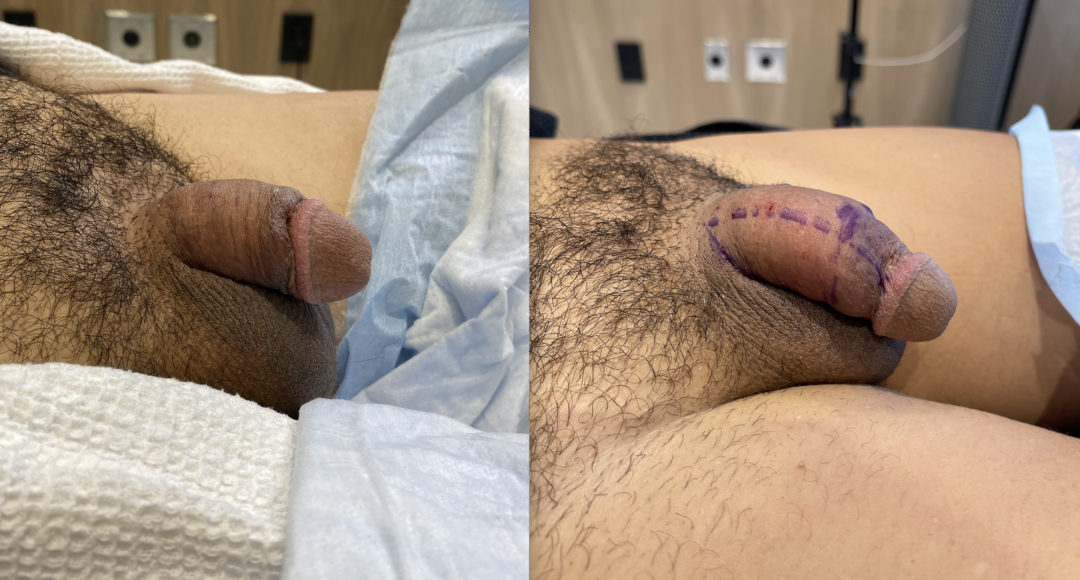 Penile Filler Before and After Photo by Dr. Emer in West Hollywood, CA