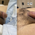 Penile Filler Before and After Photo by Dr. Emer in West Hollywood, CA