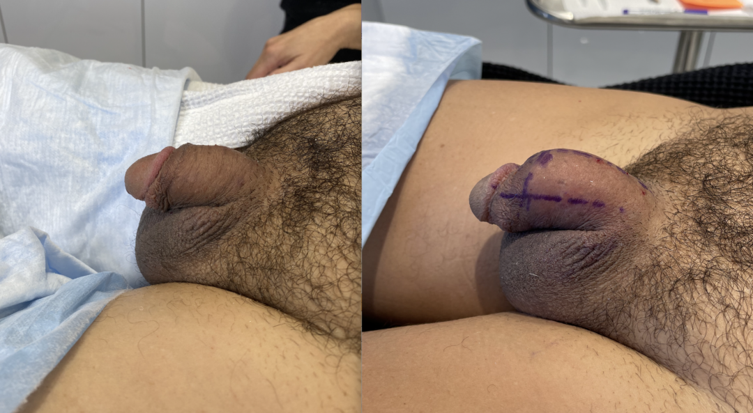 Penile Filler Before and After Photo by Dr. Emer in West Hollywood, CA