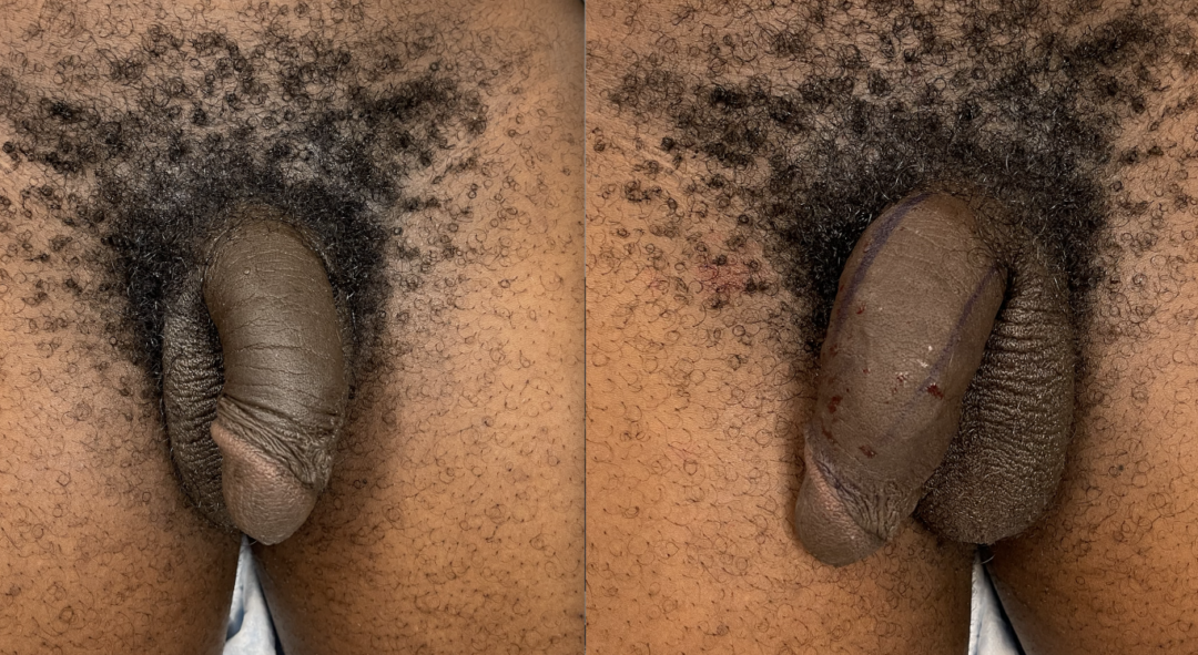 Penile Filler Before and After Photo by Dr. Emer in West Hollywood, CA