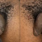 Penile Filler Before and After Photo by Dr. Emer in West Hollywood, CA