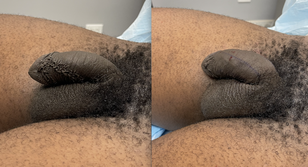 Penile Filler Before and After Photo by Dr. Emer in West Hollywood, CA