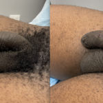 Penile Filler Before and After Photo by Dr. Emer in West Hollywood, CA