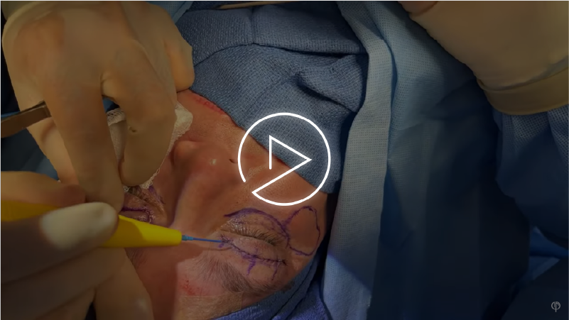 Upper Blepharoplasty video cover