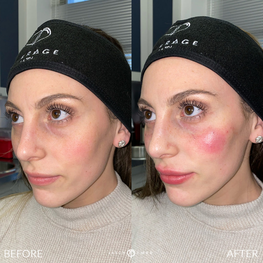 Facial Sculpting – Female Before and After Photo by Dr. Emer and Dr. Sanan in West Hollywood California