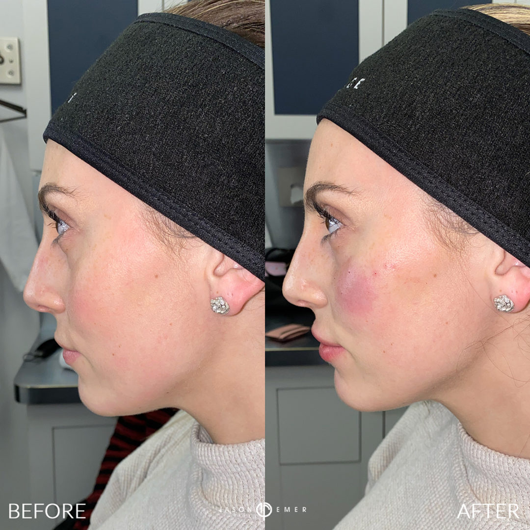 Facial Sculpting – Female Before and After Photo by Dr. Emer and Dr. Sanan in West Hollywood California