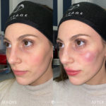 Facial Sculpting – Female Before and After Photo by Dr. Emer and Dr. Sanan in West Hollywood California