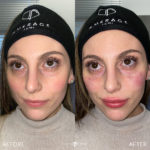 Facial Sculpting – Female Before and After Photo by Dr. Emer and Dr. Sanan in West Hollywood California