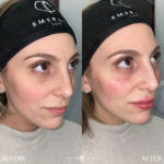 Facial Sculpting – Female Before and After Photo by Dr. Emer and Dr. Sanan in West Hollywood California