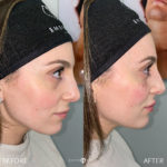 Facial Sculpting – Female Before and After Photo by Dr. Emer and Dr. Sanan in West Hollywood California