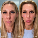 Facial Sculpting – Female Before and After Photo by Dr. Emer and Dr. Sanan in West Hollywood California