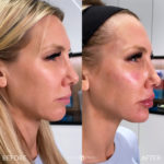 Facial Sculpting – Female Before and After Photo by Dr. Emer and Dr. Sanan in West Hollywood California