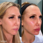 Facial Sculpting – Female Before and After Photo by Dr. Emer and Dr. Sanan in West Hollywood California