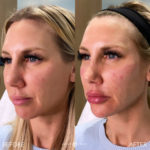 Facial Sculpting – Female Before and After Photo by Dr. Emer and Dr. Sanan in West Hollywood California