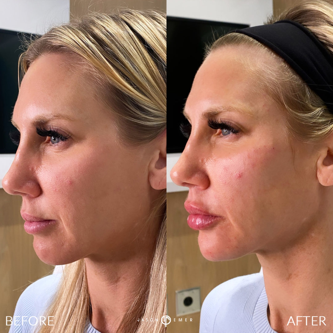 Facial Sculpting – Female Before and After Photo by Dr. Emer and Dr. Sanan in West Hollywood California