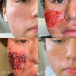 ACNE SCAR COMBINATION TREATMENT Before and After Photo by Dr. Emer and Dr. Sanan in West Hollywood California