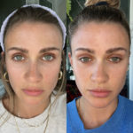 AERIFY COMPLEXION KIT Before and After Photo by Dr. Emer and Dr. Sanan in West Hollywood California