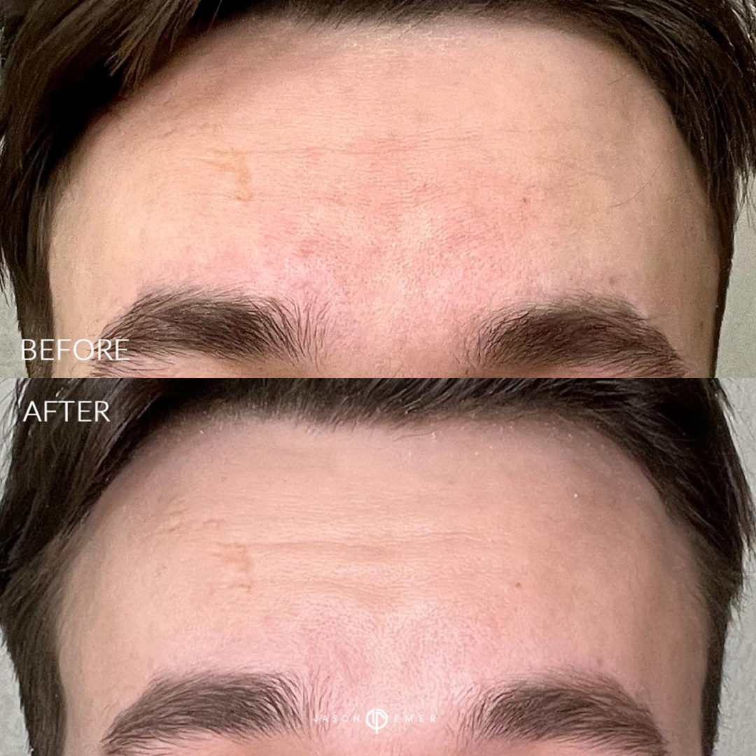 AERIFY COMPLEXION KIT Before and After Photo by Dr. Emer and Dr. Sanan in West Hollywood California