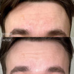 AERIFY COMPLEXION KIT Before and After Photo by Dr. Emer and Dr. Sanan in West Hollywood California