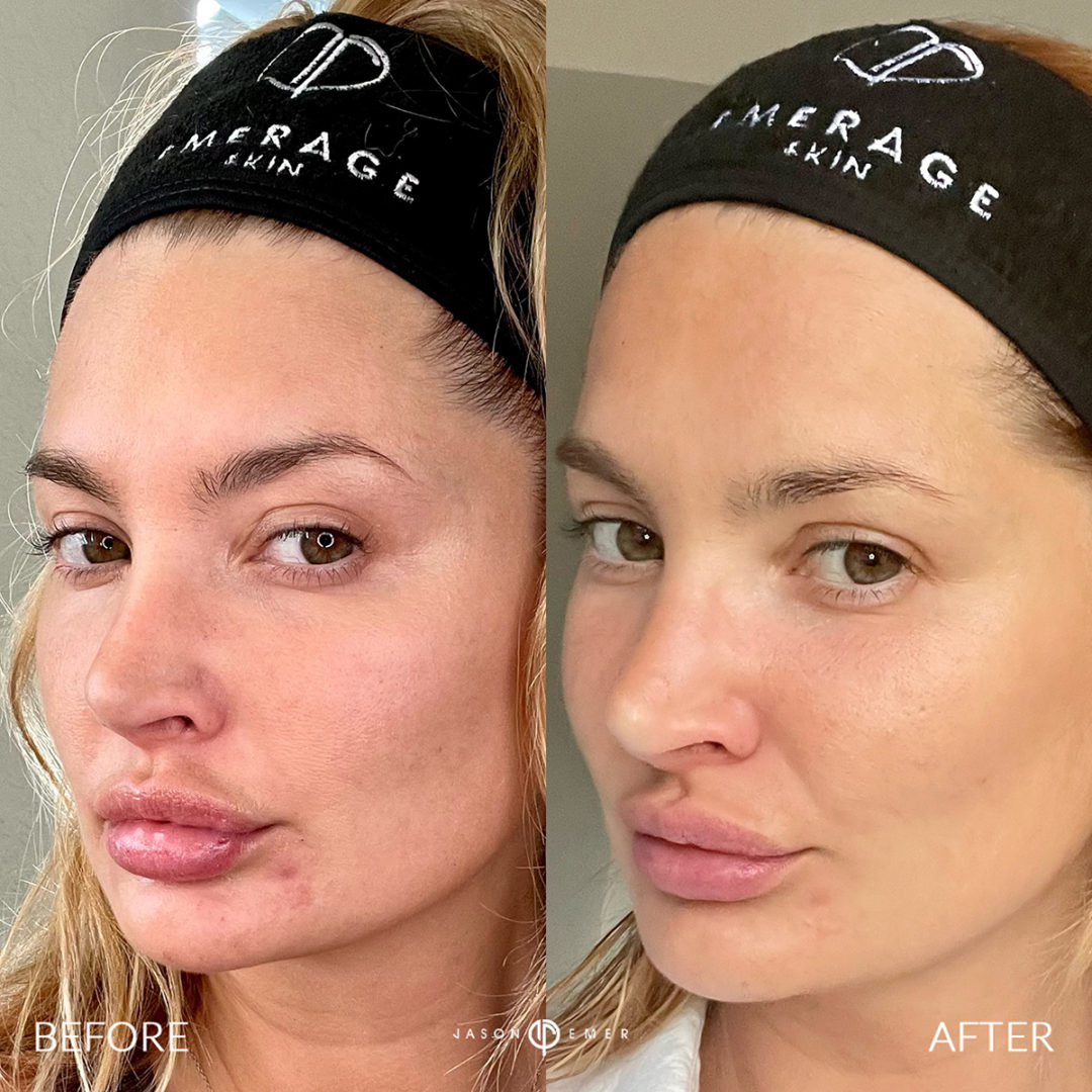 AERIFY COMPLEXION KIT Before and After Photo by Dr. Emer and Dr. Sanan in West Hollywood California