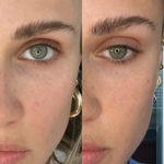 AERIFY COMPLEXION KIT Before and After Photo by Dr. Emer and Dr. Sanan in West Hollywood California