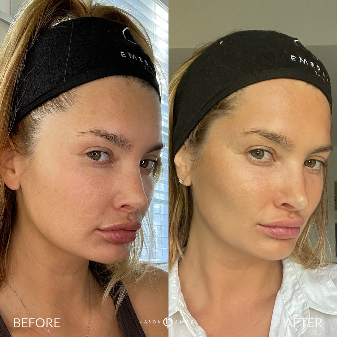 AERIFY COMPLEXION KIT Before and After Photo by Dr. Emer and Dr. Sanan in West Hollywood California