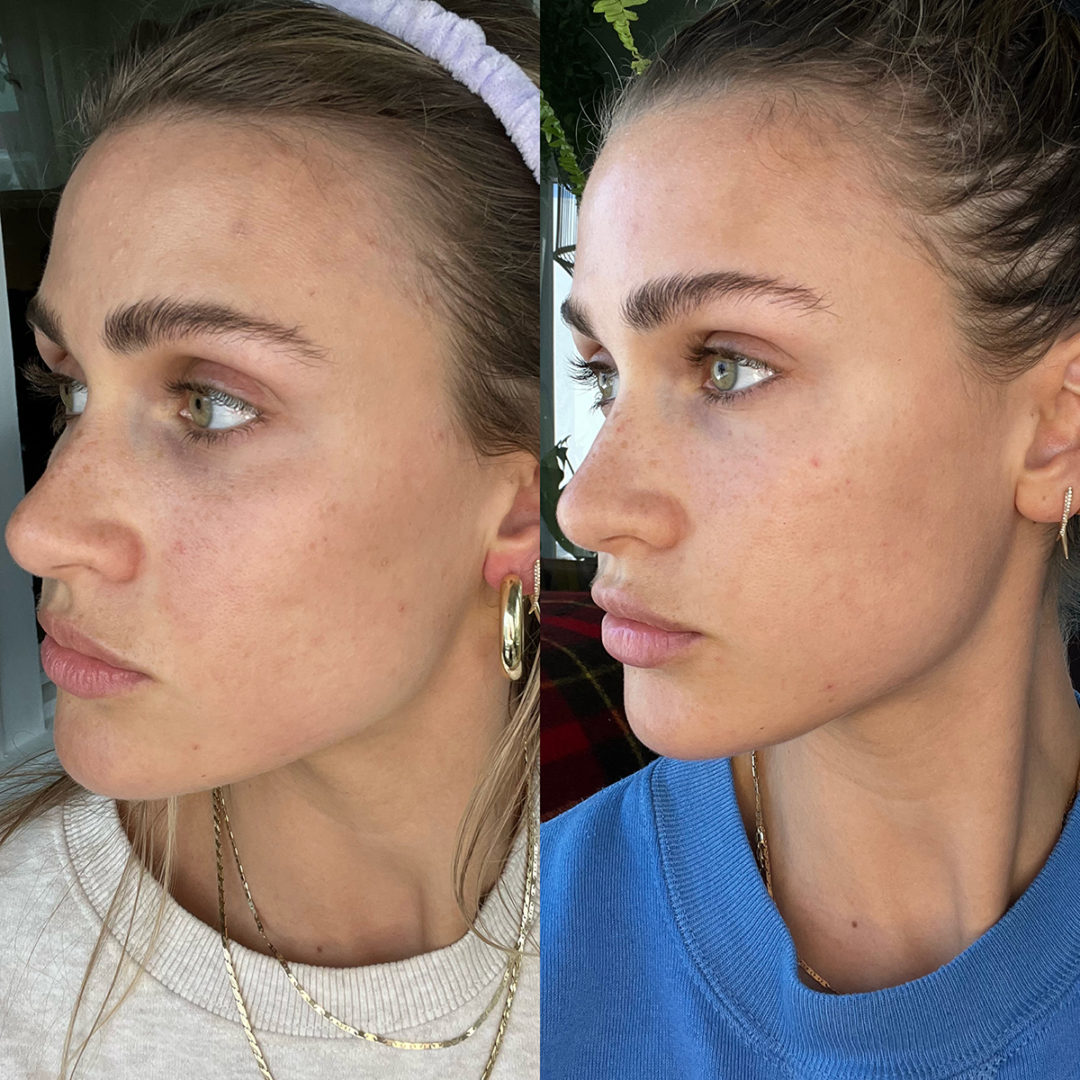 AERIFY COMPLEXION KIT Before and After Photo by Dr. Emer and Dr. Sanan in West Hollywood California