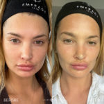 AERIFY COMPLEXION KIT Before and After Photo by Dr. Emer and Dr. Sanan in West Hollywood California