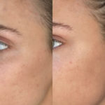 AERIFY COMPLEXION KIT Before and After Photo by Dr. Emer and Dr. Sanan in West Hollywood California