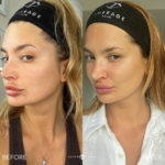 AERIFY COMPLEXION KIT Before and After Photo by Dr. Emer and Dr. Sanan in West Hollywood California