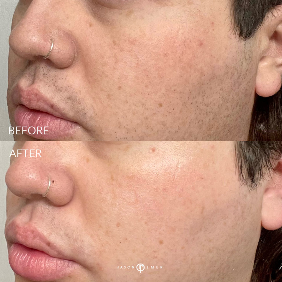 AERIFY COMPLEXION KIT Before and After Photo by Dr. Emer and Dr. Sanan in West Hollywood California