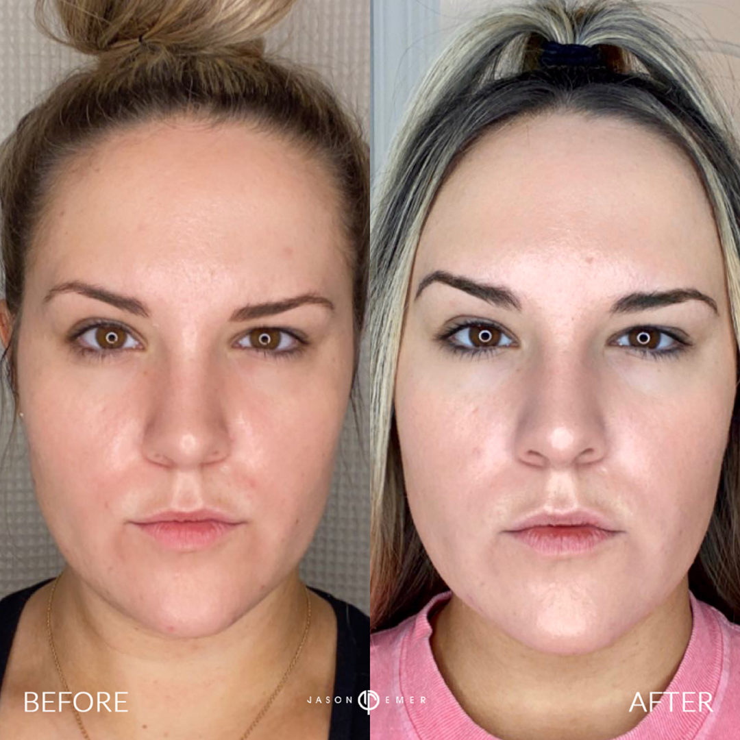 AERIFY COMPLEXION REVIVAL PEELING KIT Before and After Photo by Dr. Emer and Dr. Sanan in West Hollywood California