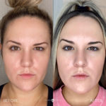 AERIFY COMPLEXION REVIVAL PEELING KIT Before and After Photo by Dr. Emer and Dr. Sanan in West Hollywood California