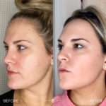 AERIFY COMPLEXION REVIVAL PEELING KIT Before and After Photo by Dr. Emer and Dr. Sanan in West Hollywood California