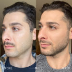 AERIFY COMPLEXION REVIVAL PEELING KIT Before and After Photo by Dr. Emer and Dr. Sanan in West Hollywood California