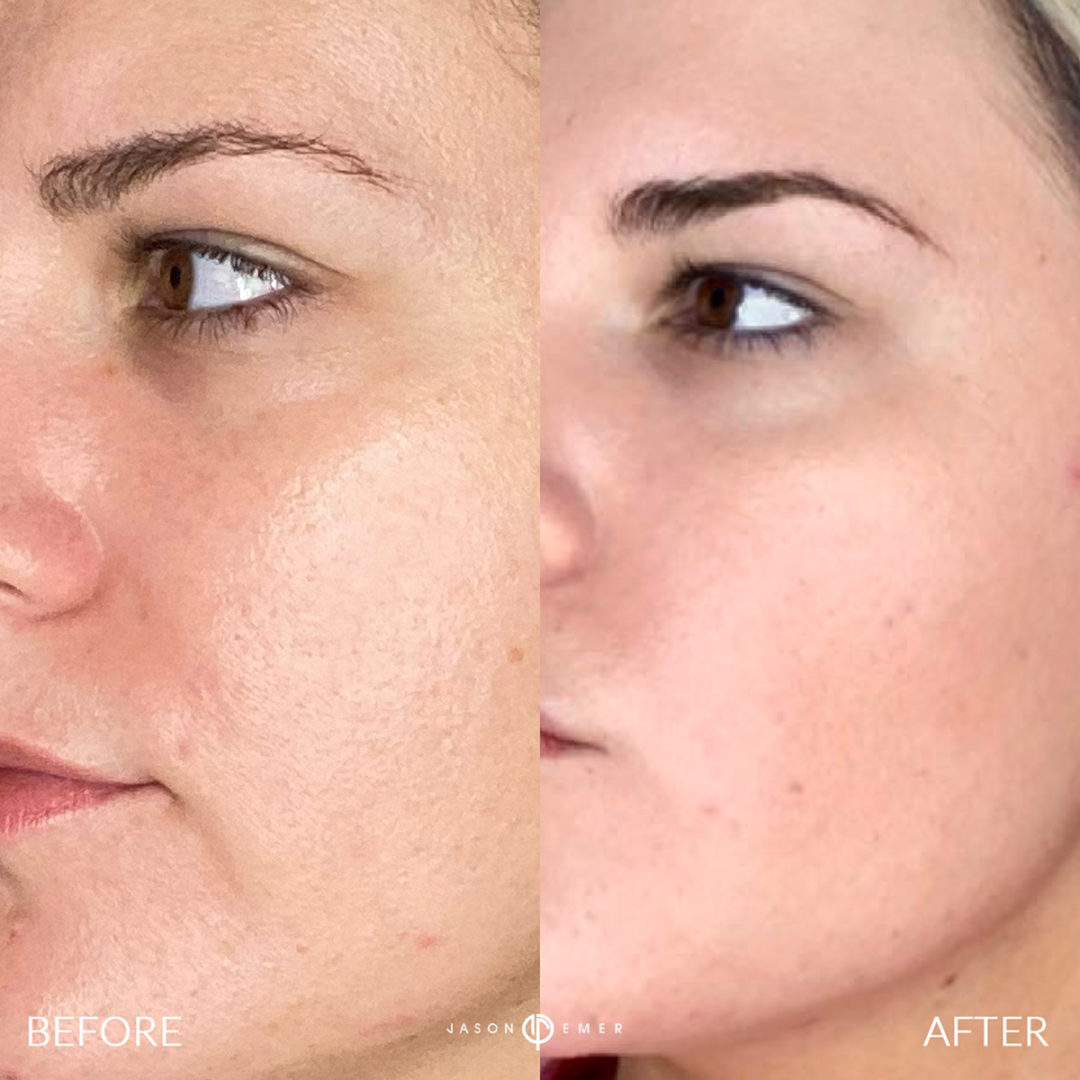 AERIFY COMPLEXION REVIVAL PEELING KIT Before and After Photo by Dr. Emer and Dr. Sanan in West Hollywood California