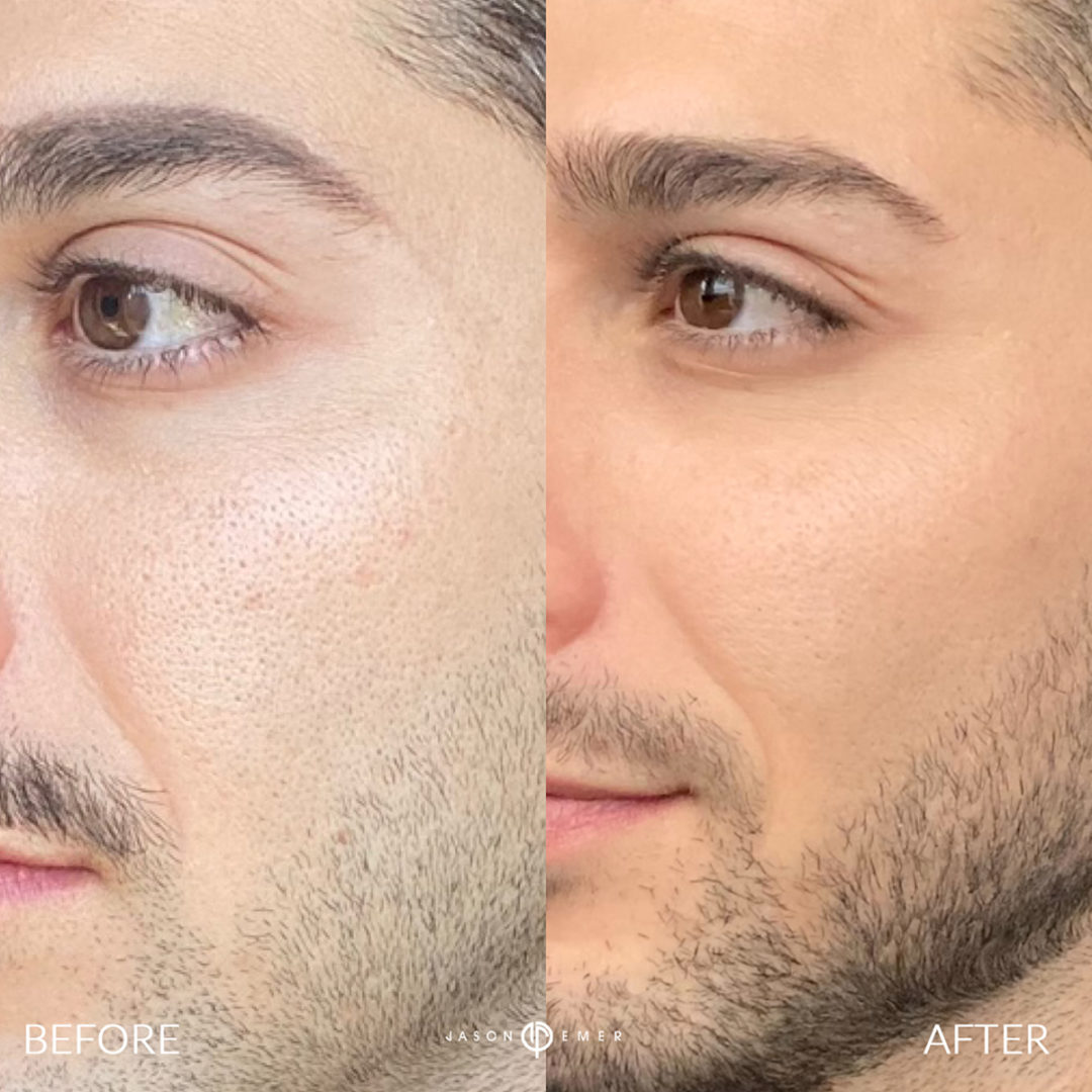 AERIFY COMPLEXION REVIVAL PEELING KIT Before and After Photo by Dr. Emer and Dr. Sanan in West Hollywood California