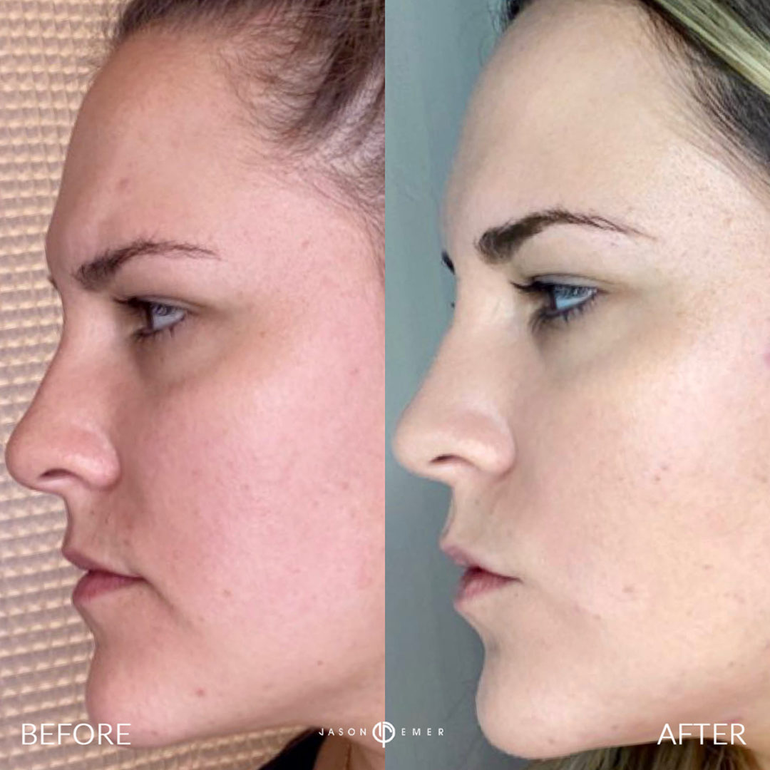 AERIFY COMPLEXION REVIVAL PEELING KIT Before and After Photo by Dr. Emer and Dr. Sanan in West Hollywood California