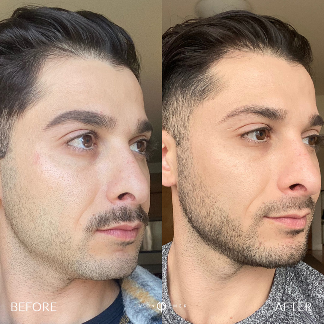 AERIFY COMPLEXION REVIVAL PEELING KIT Before and After Photo by Dr. Emer and Dr. Sanan in West Hollywood California