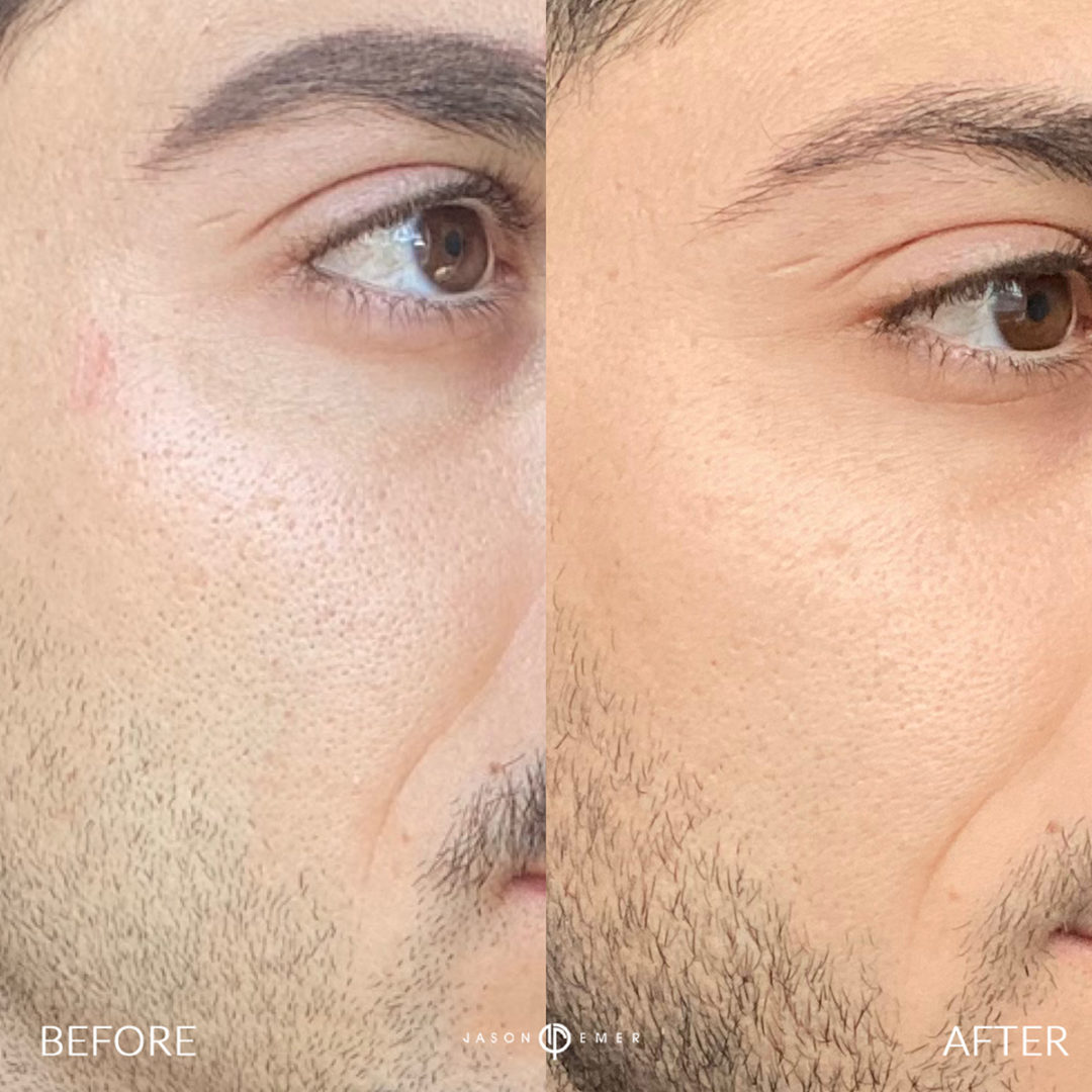 AERIFY COMPLEXION REVIVAL PEELING KIT Before and After Photo by Dr. Emer and Dr. Sanan in West Hollywood California