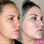 AERIFY COMPLEXION REVIVAL PEELING KIT Before and After Photo by Dr. Emer and Dr. Sanan in West Hollywood California