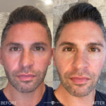 AERIFY COMPLEXION REVIVAL PEELING KIT Before and After Photo by Dr. Emer and Dr. Sanan in West Hollywood California