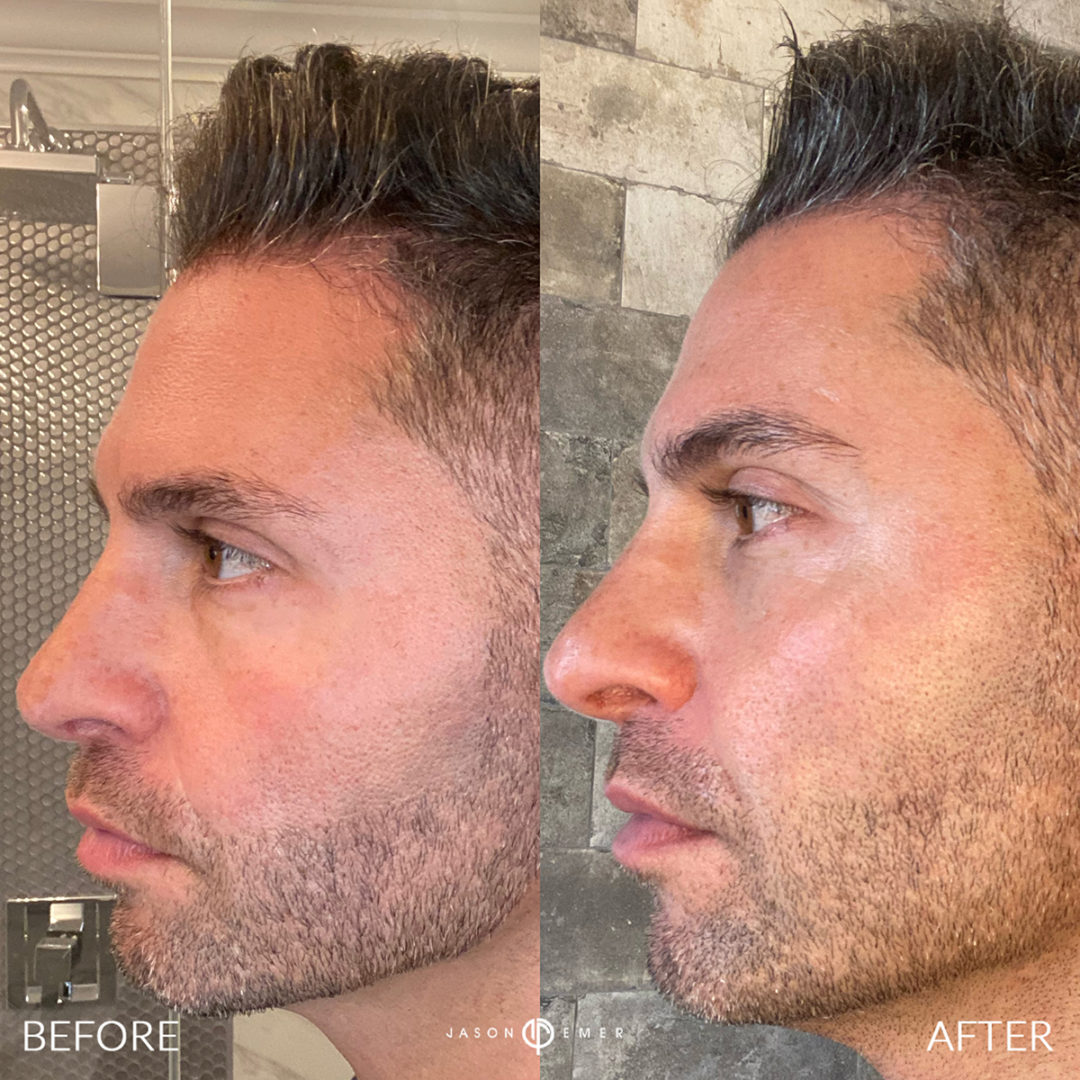 AERIFY COMPLEXION REVIVAL PEELING KIT Before and After Photo by Dr. Emer and Dr. Sanan in West Hollywood California